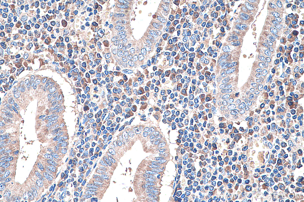 IHC staining of human appendicitis using 60294-1-Ig