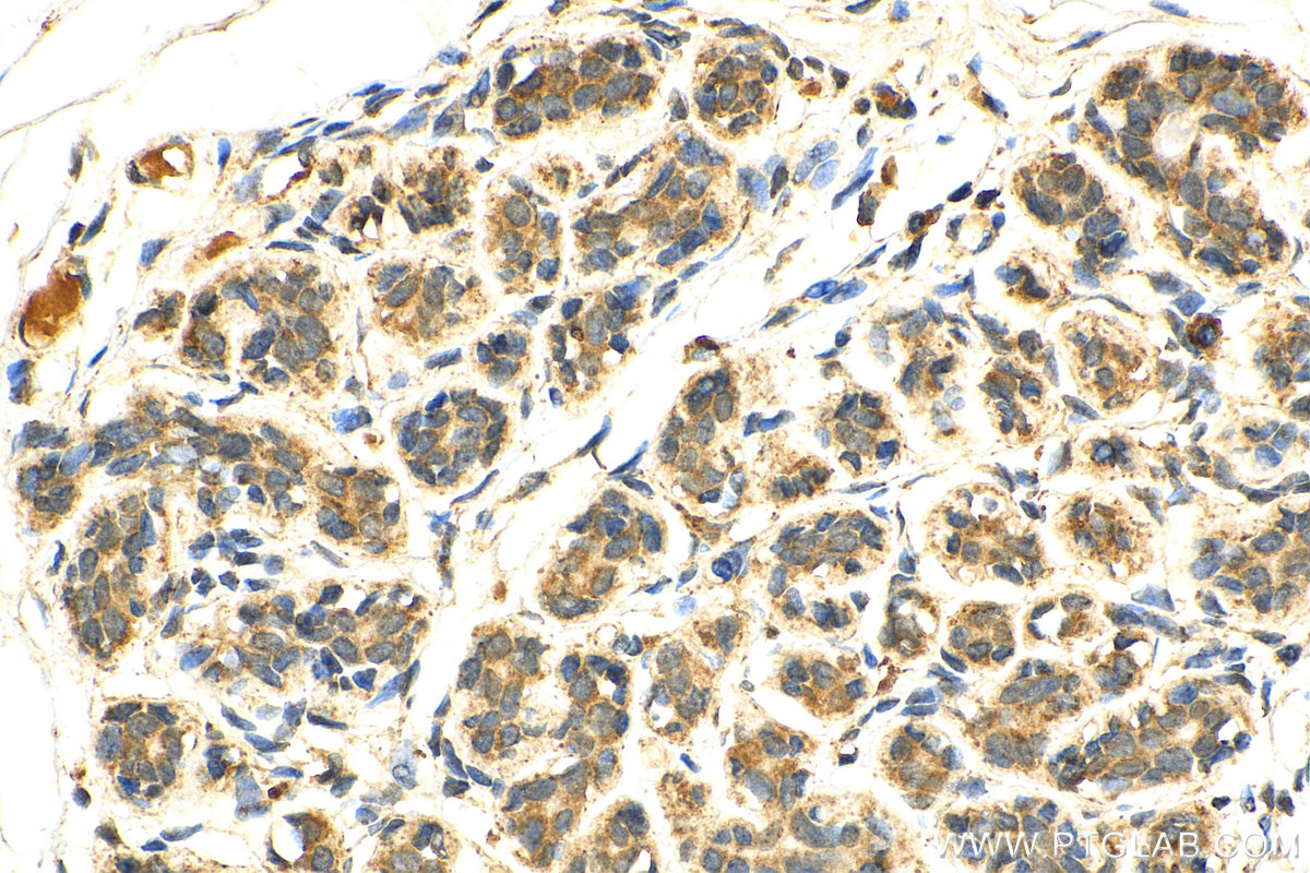 IHC staining of human breast cancer using 17968-1-AP