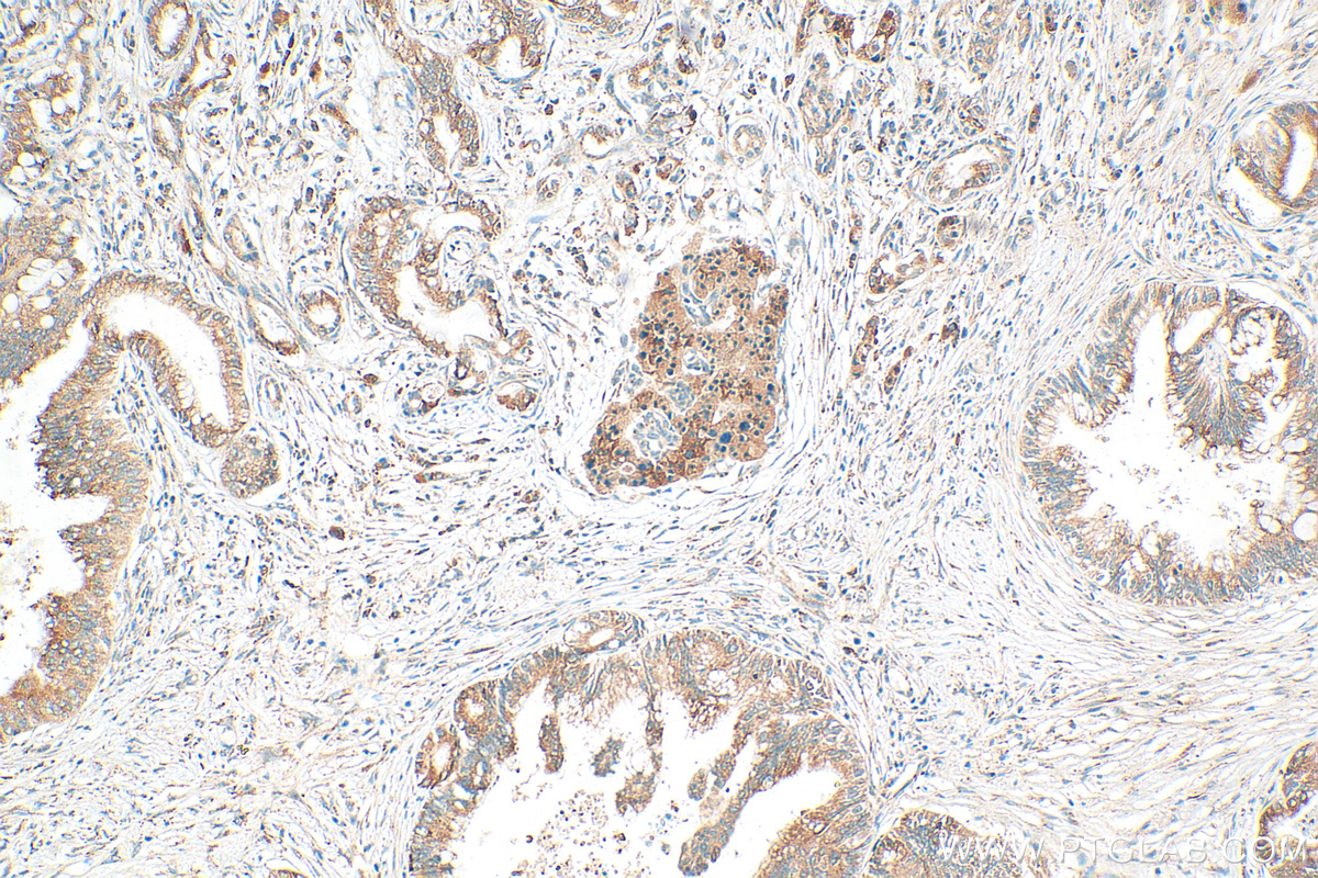 IHC staining of human pancreas cancer using 30133-1-AP (same clone as 30133-1-PBS)