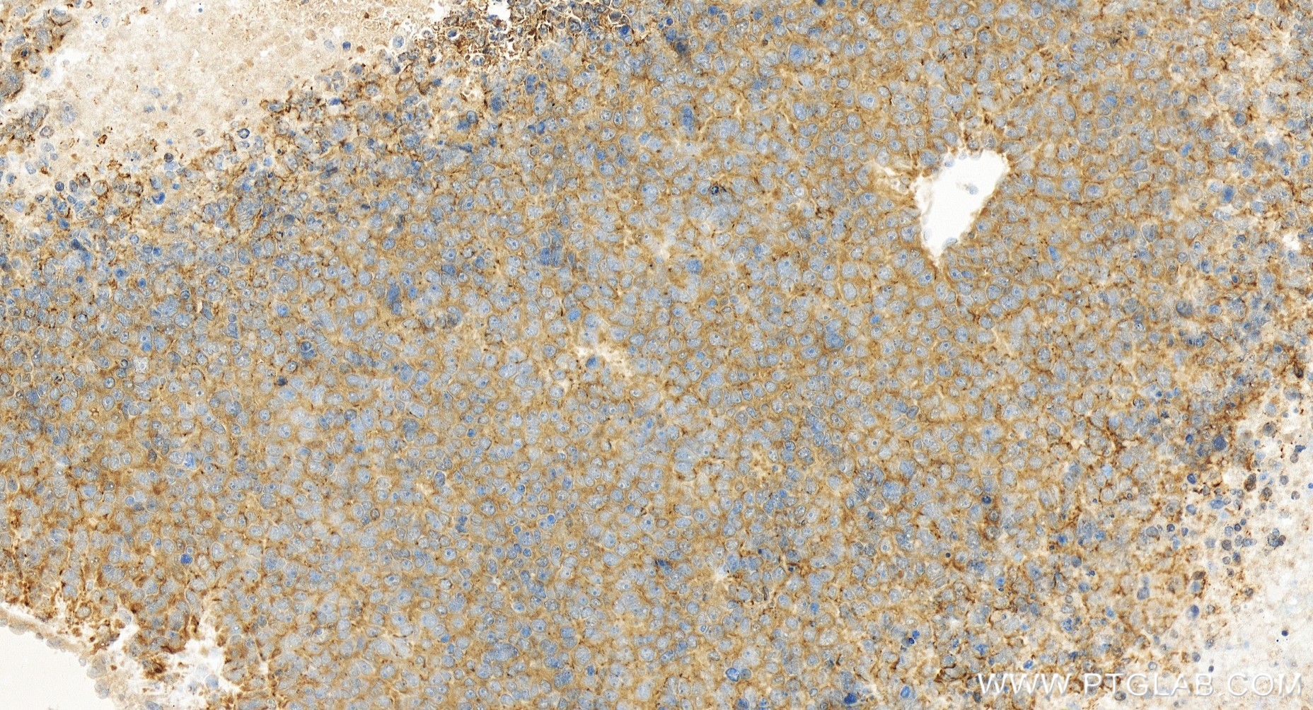 Immunohistochemical analysis of paraffin-embedded human liver cancer tissue slide using <a class='green' href='/productredirect?CatalogNo=84941-1-RR' target='_blank'>84941-1-RR</a> (PLCG1 antibody) at dilution of 1:500 (under 20x lens). Heat mediated antigen retrieval with Tris-EDTA buffer (pH 9.0). This data was developed using the same antibody clone with 84941-1-PBS in a different storage buffer formulation. IHC staining of human liver cancer using 84941-1-RR (same clone as 84941-1-PBS)