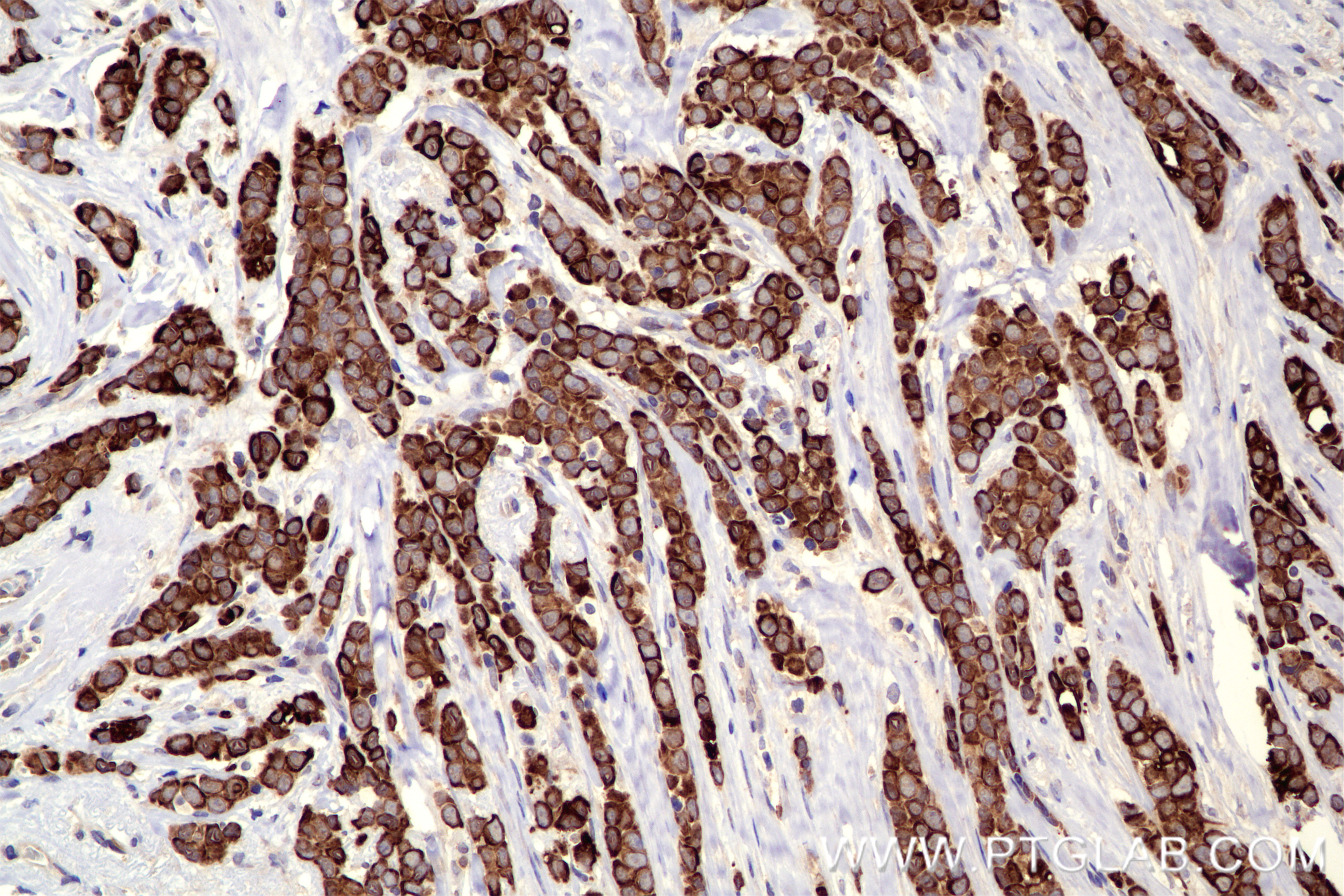 Immunohistochemical analysis of paraffin-embedded human breast cancer tissue slide using <a class='green' href='/productredirect?CatalogNo=84941-1-RR' target='_blank'>84941-1-RR</a> (PLCG1 antibody) at dilution of 1:500 (under 20x lens). Heat mediated antigen retrieval with Tris-EDTA buffer (pH 9.0). This data was developed using the same antibody clone with 84941-1-PBS in a different storage buffer formulation. IHC staining of human breast cancer using 84941-1-RR (same clone as 84941-1-PBS)