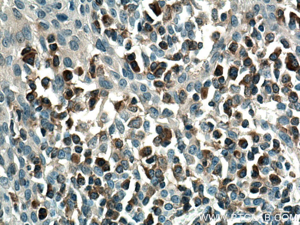 IHC staining of human tonsillitis using 67011-1-Ig