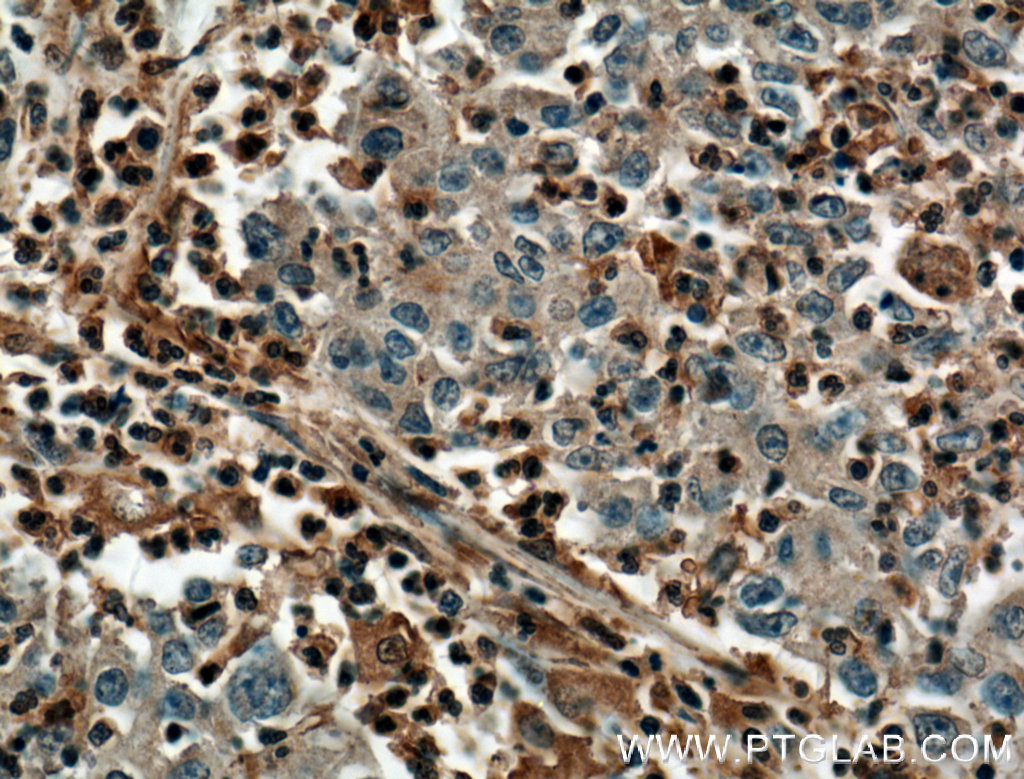 IHC staining of human colon cancer using 66431-1-Ig (same clone as 66431-1-PBS)