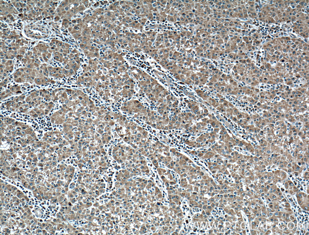 IHC staining of human liver cancer using 66399-1-Ig