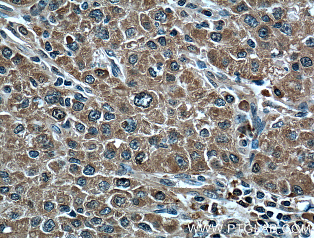 IHC staining of human liver cancer using 66399-1-Ig