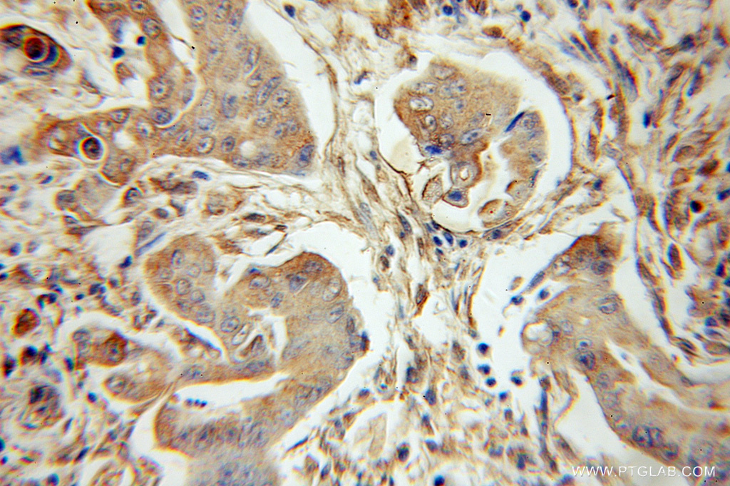 IHC staining of human colon cancer using 10977-1-AP