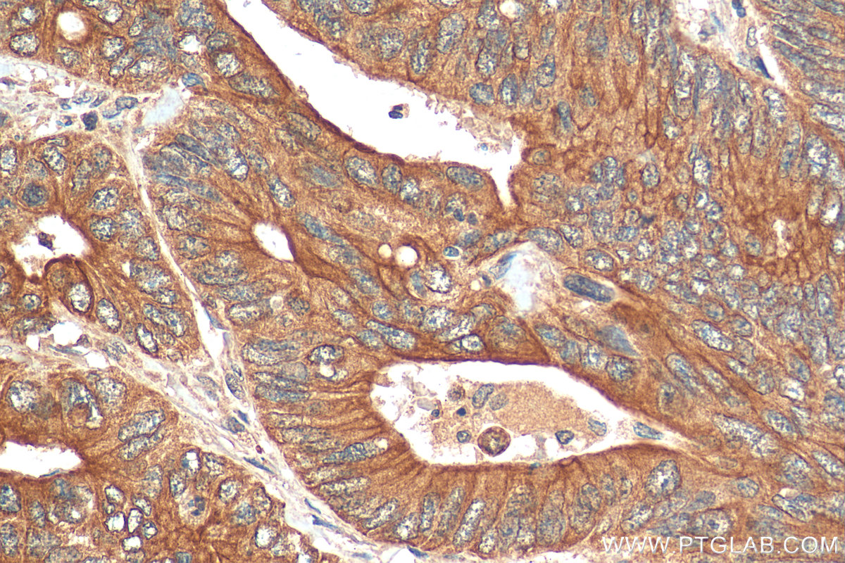 IHC staining of human colon cancer using 28750-1-AP