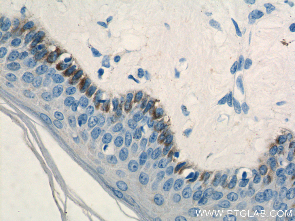 IHC staining of human skin cancer using 12475-1-AP