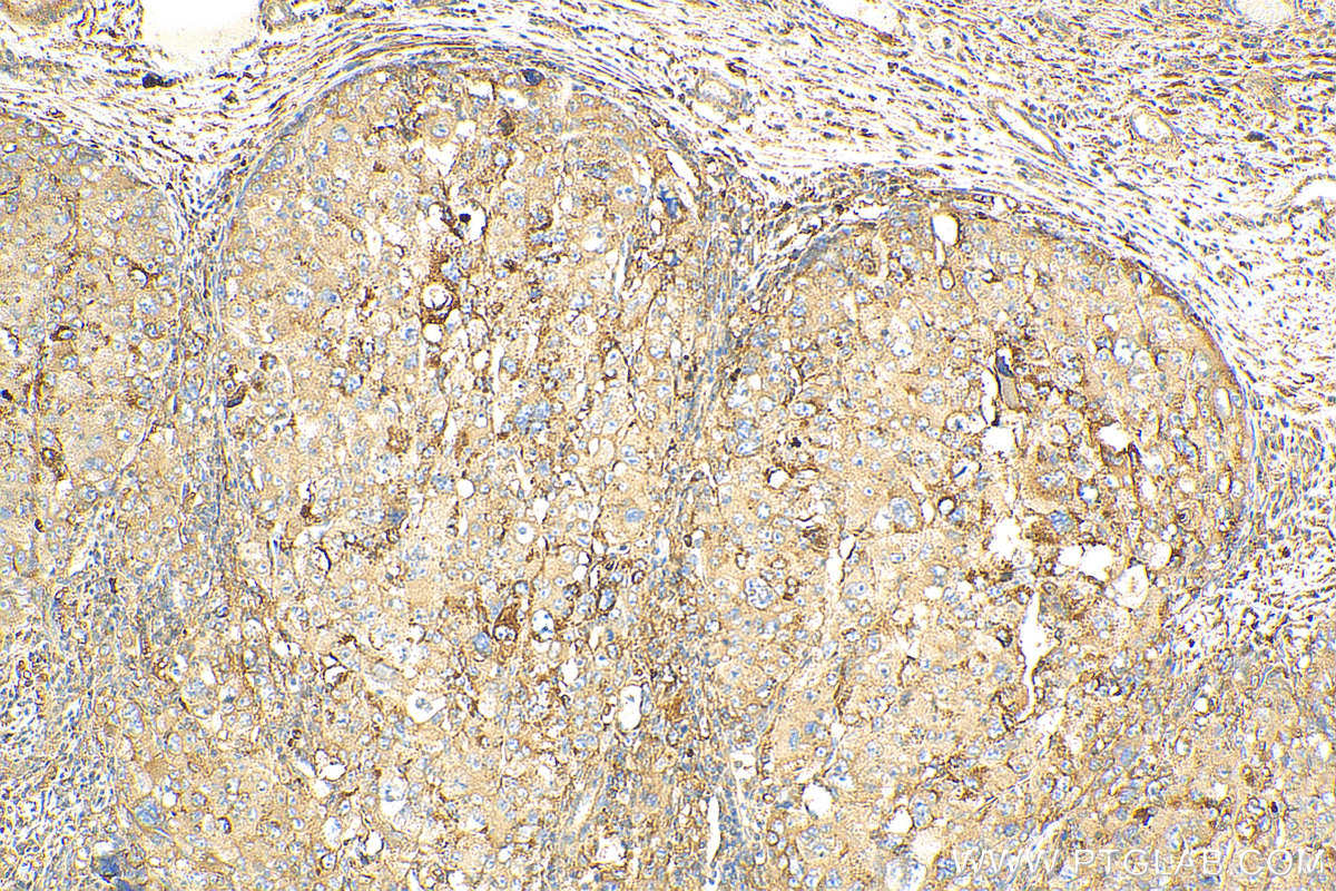 IHC staining of human liver cancer using 21214-1-AP
