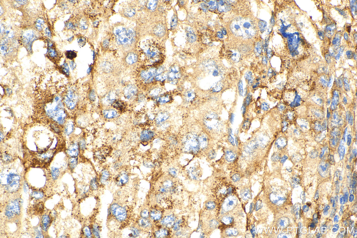 IHC staining of human liver cancer using 21214-1-AP