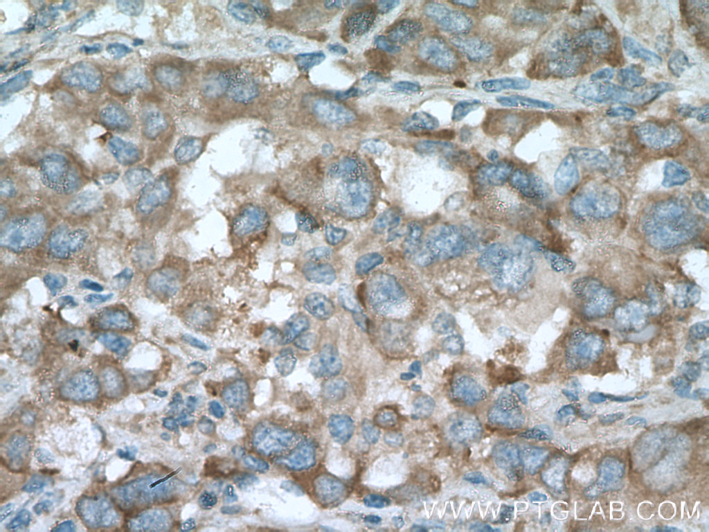 IHC staining of human liver cancer using 66342-1-Ig