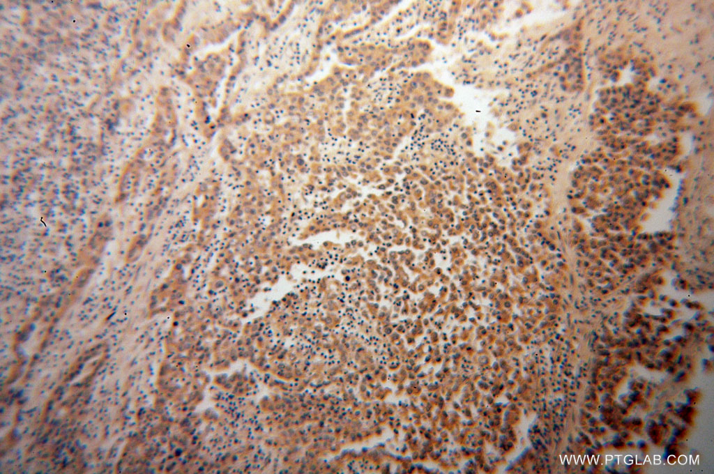 IHC staining of human pancreas cancer using 60058-1-Ig (same clone as 60058-1-PBS)
