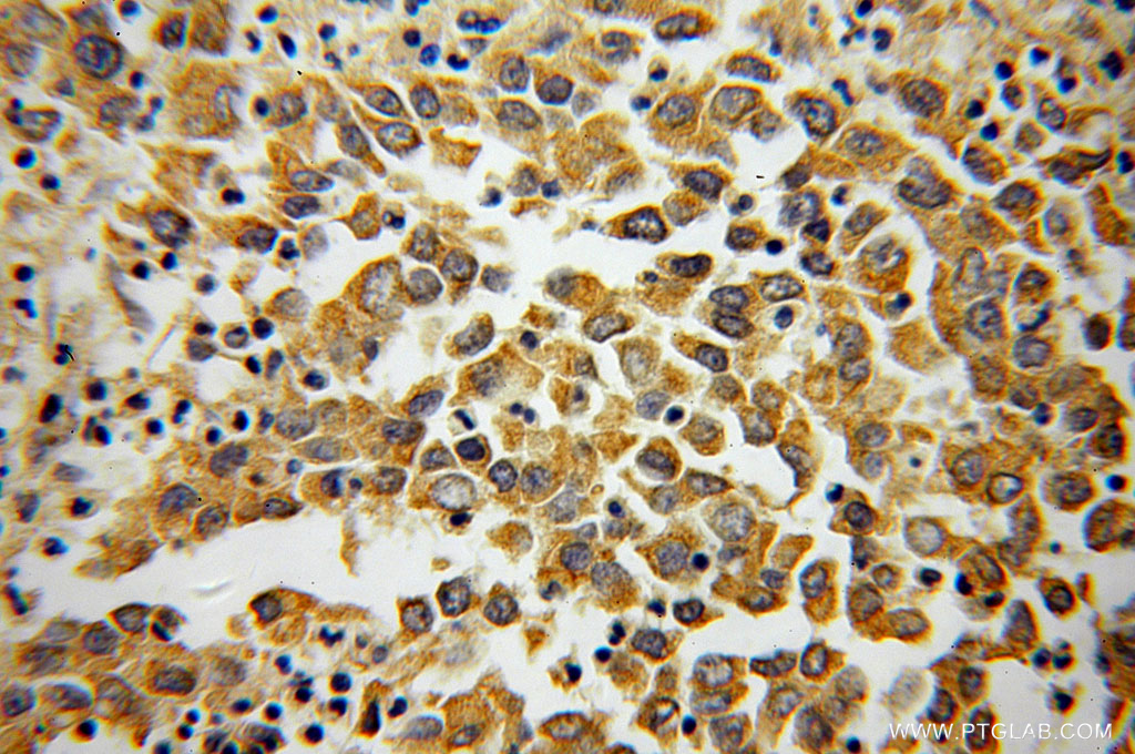 IHC staining of human pancreas cancer using 60058-1-Ig (same clone as 60058-1-PBS)