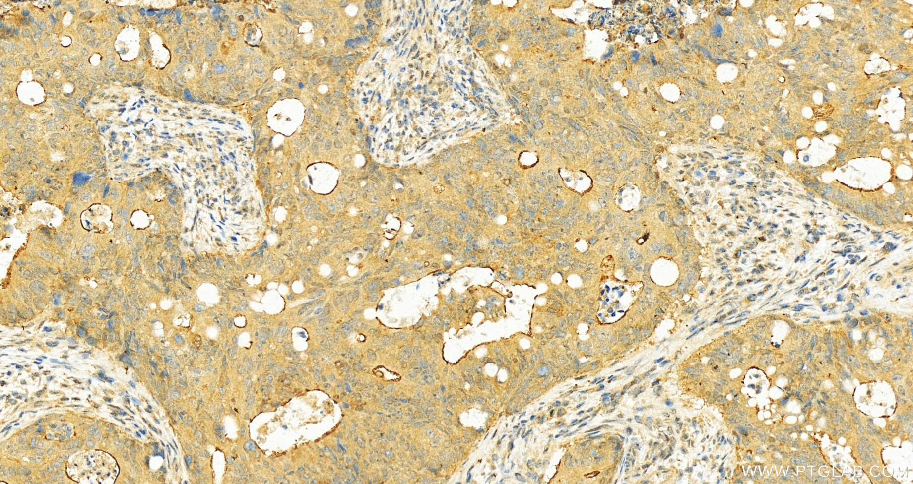 IHC staining of human colon cancer using 55212-1-AP