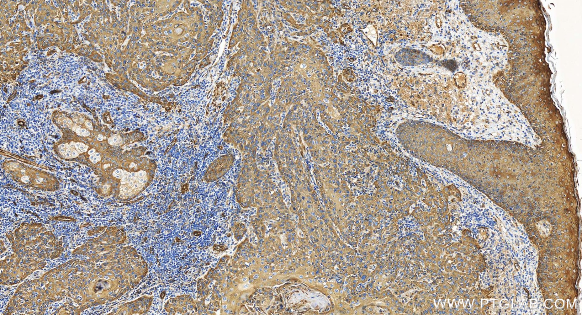 IHC staining of human skin cancer using 86323-1-RR