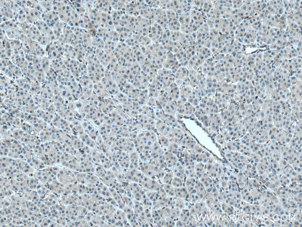 IHC staining of human liver cancer using 28028-1-AP