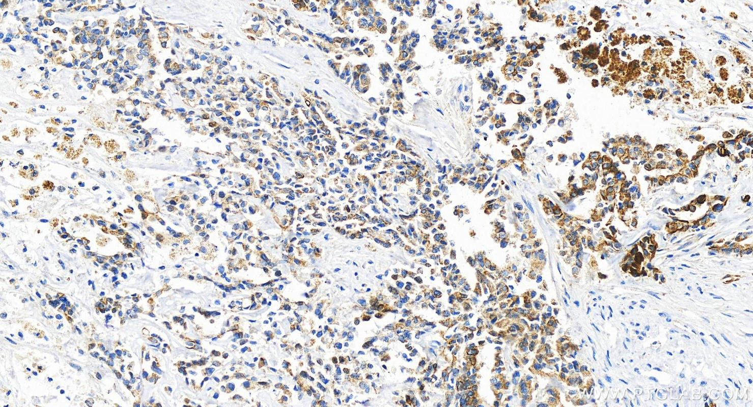 IHC staining of human intrahepatic cholangiocarcinoma using 83449-4-RR