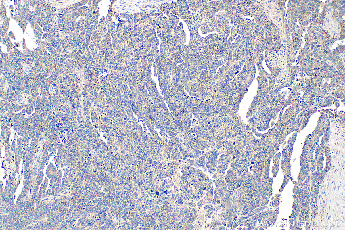 IHC staining of human ovary tumor using 16521-1-AP