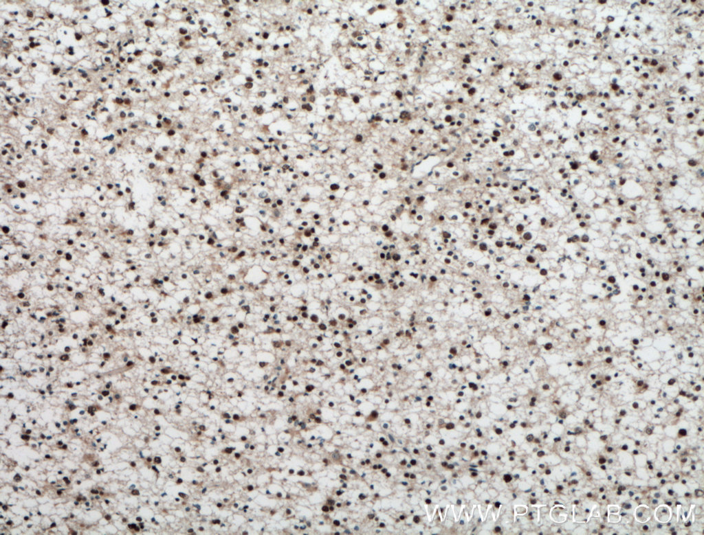 IHC staining of human gliomas using 11190-2-AP