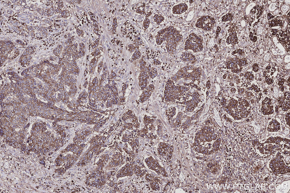 IHC staining of human stomach cancer using 10666-1-AP