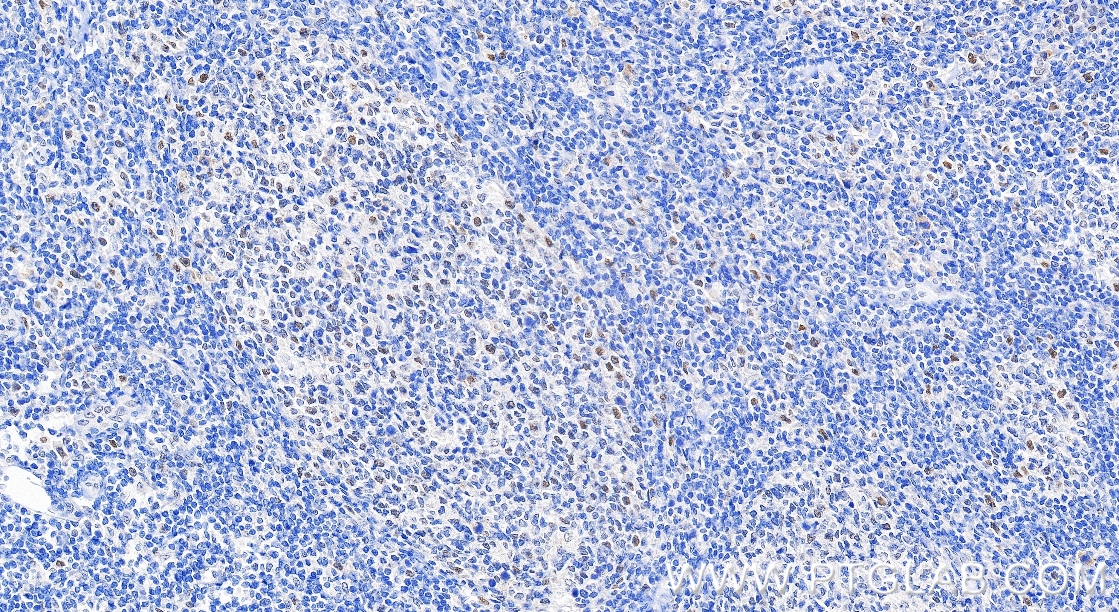 IHC staining of human tonsillitis using 83456-6-RR IHC staining of human tonsillitis using 83456-6-RR