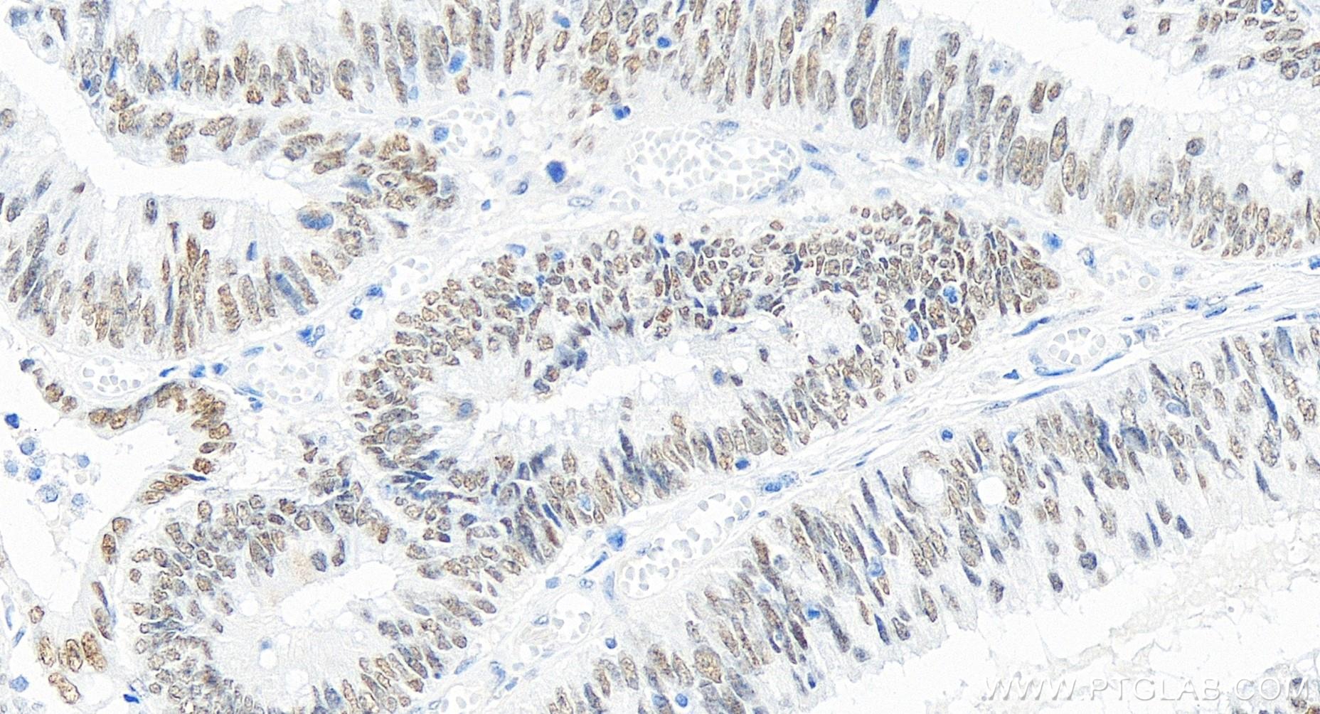 IHC staining of human colon cancer using 84894-5-RR
