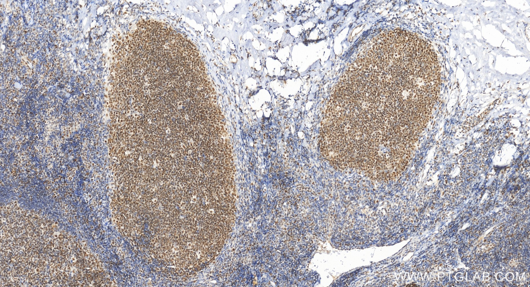 Immunohistochemical analysis of paraffin-embedded human tonsillitis tissue slide using <a class='green' href='/productredirect?CatalogNo=84894-5-RR' target='_blank'>84894-5-RR</a> (PMS2 antibody) at dilution of 1:500 (under 20x lens). Heat mediated antigen retrieval with Tris-EDTA buffer (pH 9.0). This data was developed using the same antibody clone with 84894-5-PBS in a different storage buffer formulation. IHC staining of human tonsillitis using 84894-5-RR (same clone as 84894-5-PBS)