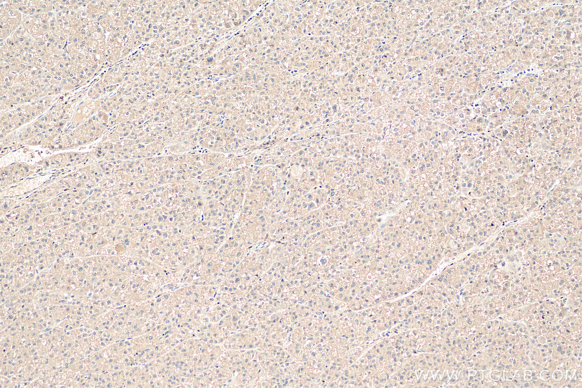 IHC staining of human liver cancer using 11442-1-AP