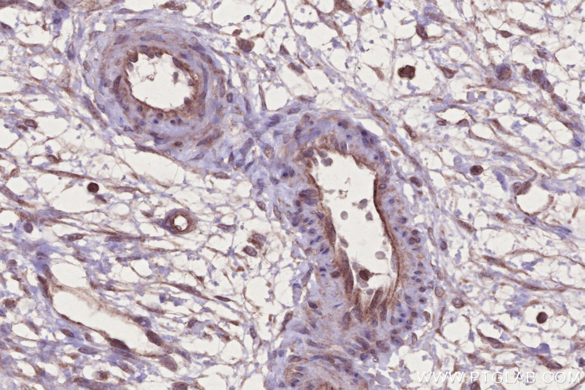 IHC staining of human ovary cancer using 14261-1-AP IHC staining of human ovary cancer using 14261-1-AP