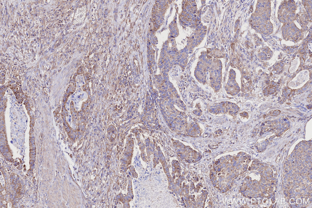 IHC staining of human stomach cancer using 68309-1-Ig
