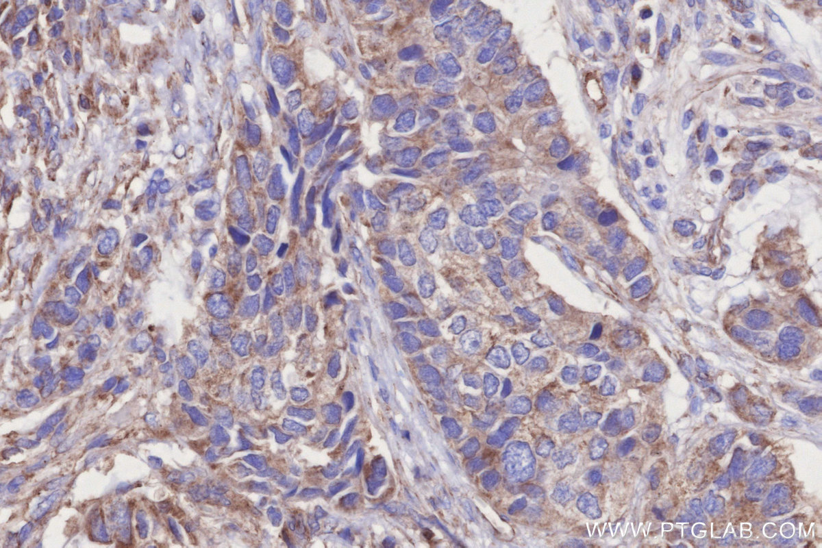 IHC staining of human stomach cancer using 68309-1-Ig