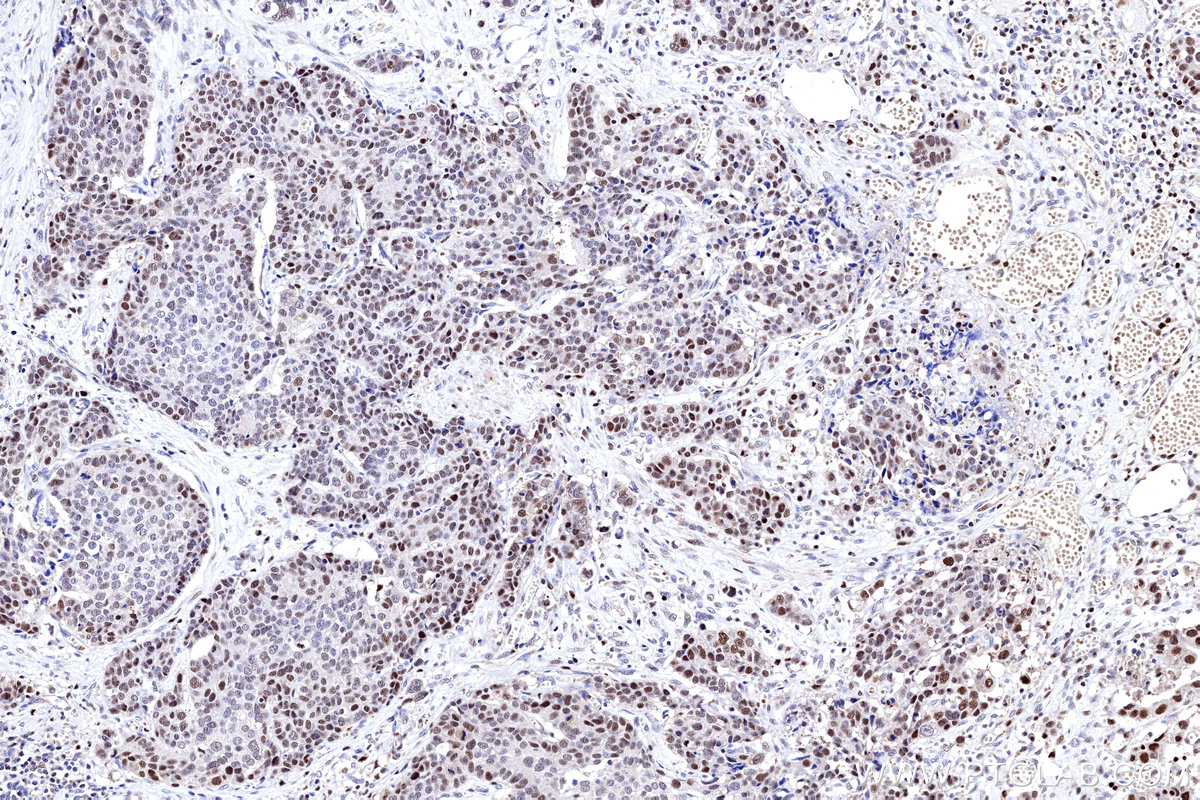 IHC staining of human stomach cancer using 31394-1-AP IHC staining of human stomach cancer using 31394-1-AP