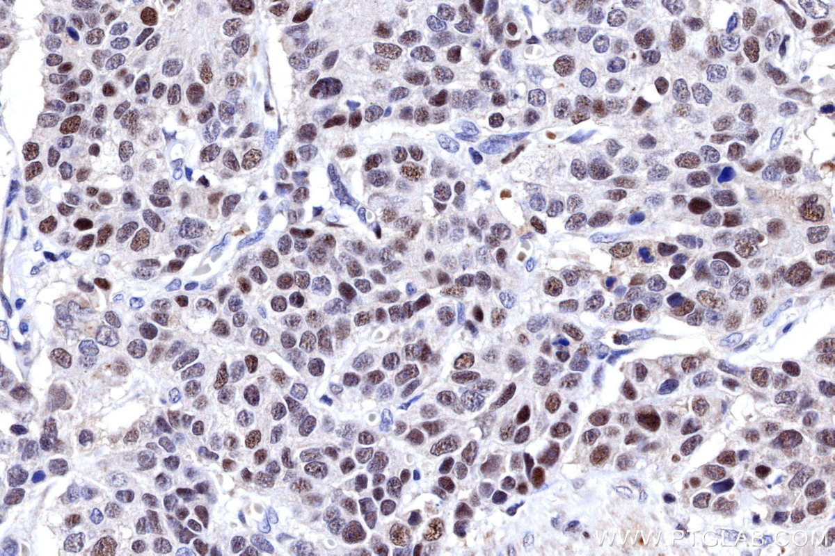 IHC staining of human stomach cancer using 31394-1-AP