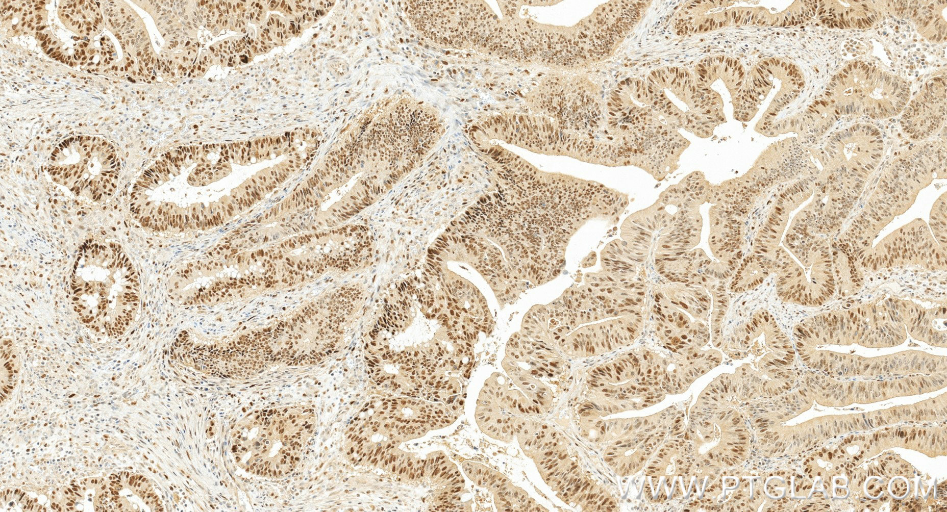 IHC staining of human colon cancer using 86197-2-RR