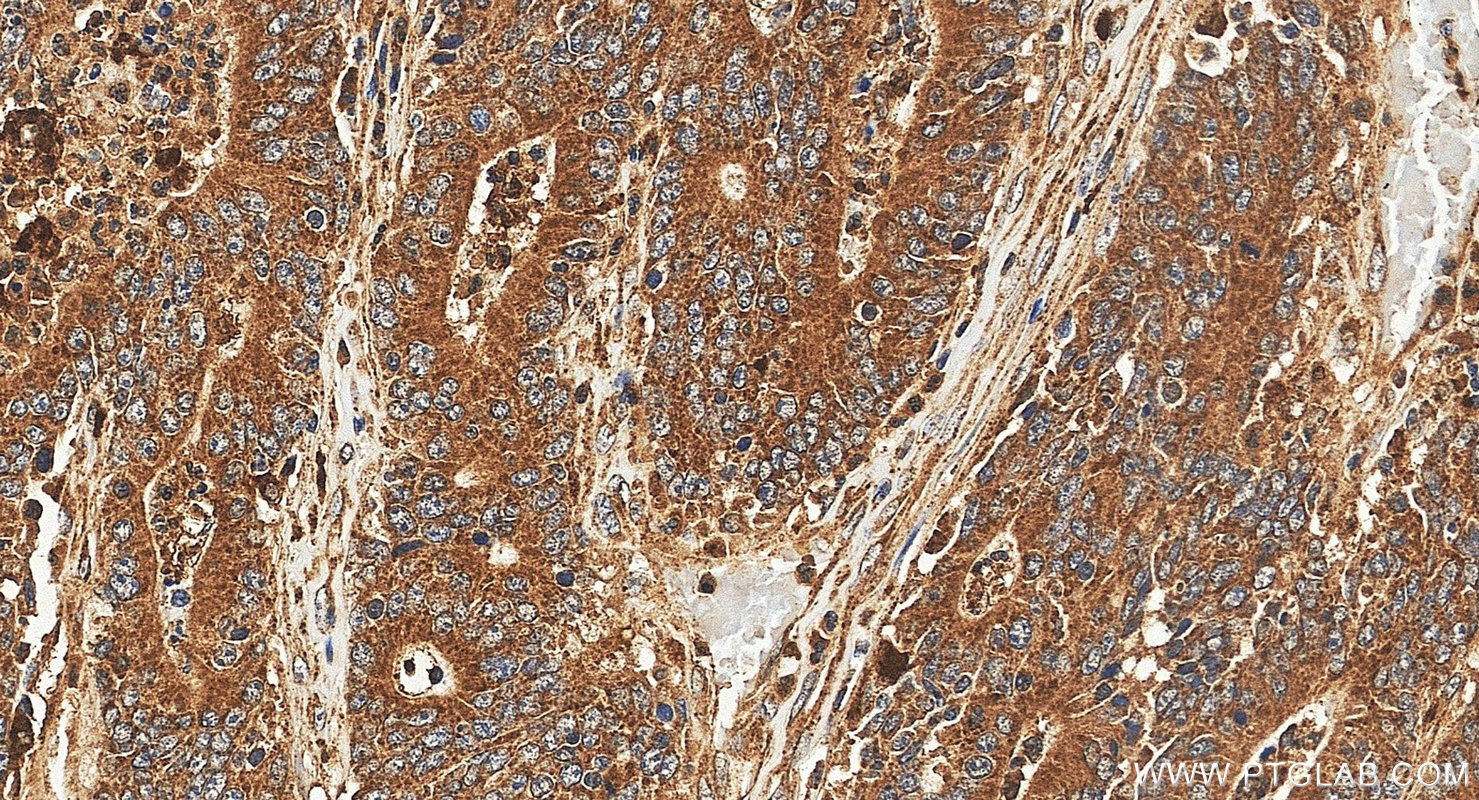 IHC staining of human colon cancer using 10997-2-AP (same clone as 10997-2-PBS)