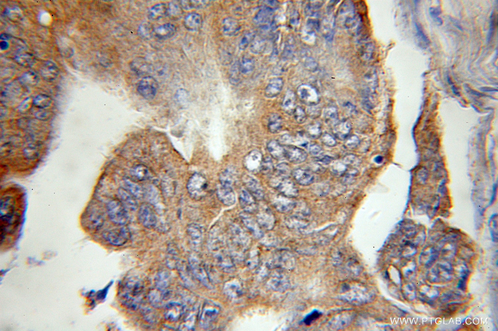 IHC staining of human colon cancer using 10997-2-AP