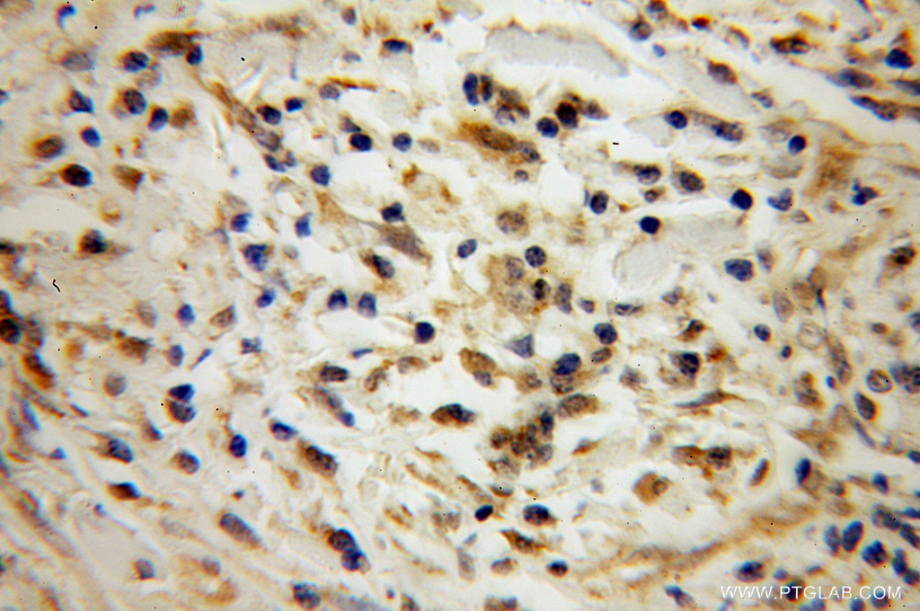 IHC staining of human cervical cancer using 13428-1-AP