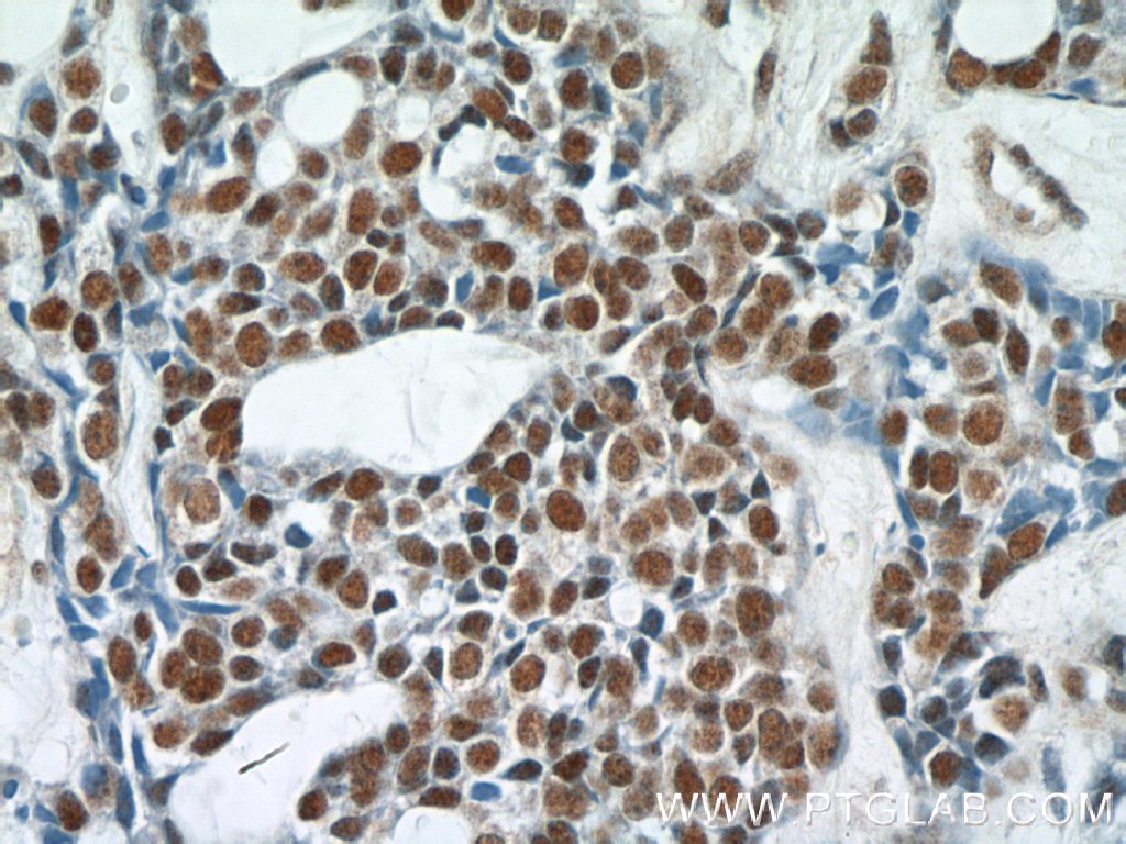 IHC staining of human cervical cancer using 15334-1-AP