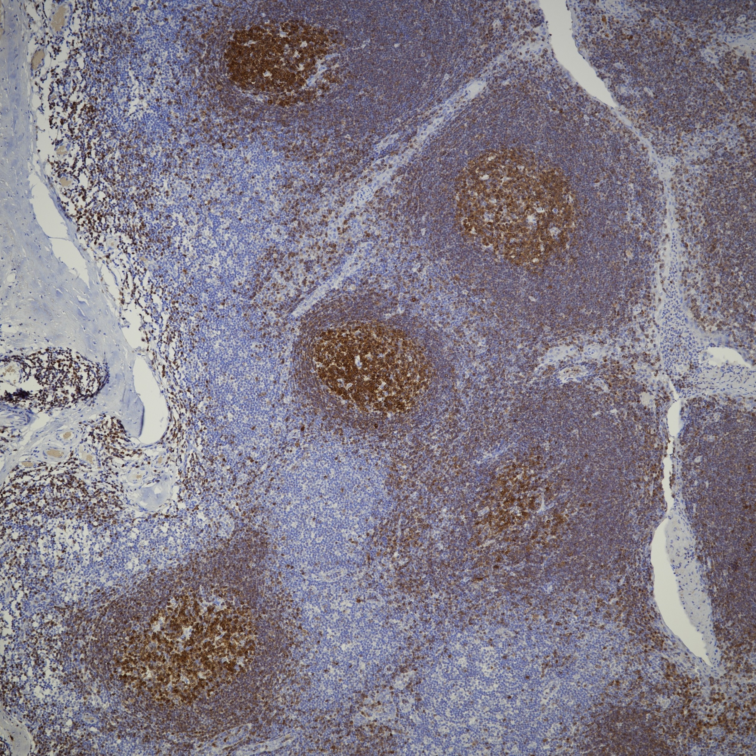 IHC staining of human tonsil using 66659-1-Ig IHC staining of human tonsil using 66659-1-Ig