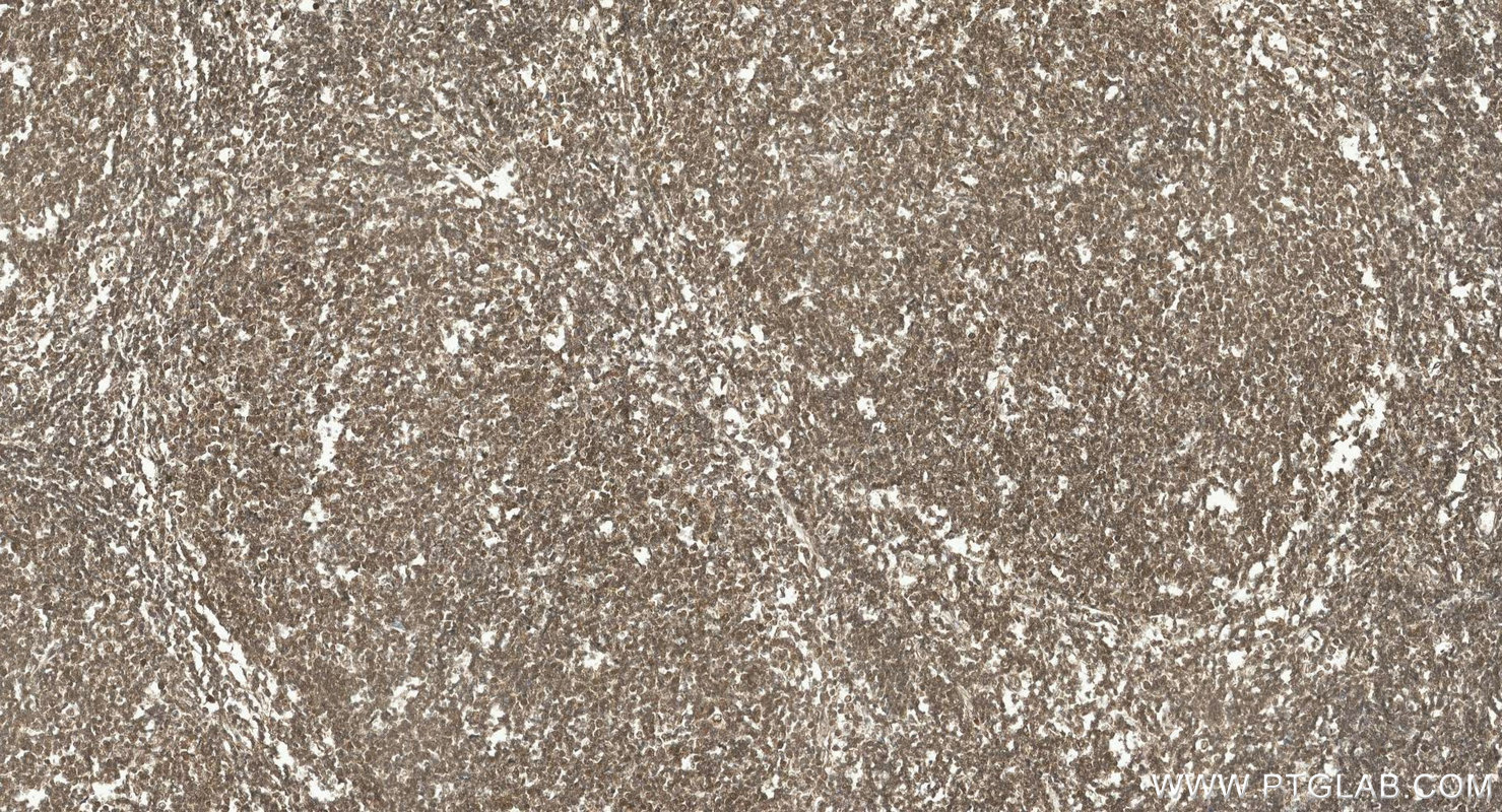 IHC staining of human lymphoma using 10867-2-AP IHC staining of human lymphoma using 10867-2-AP