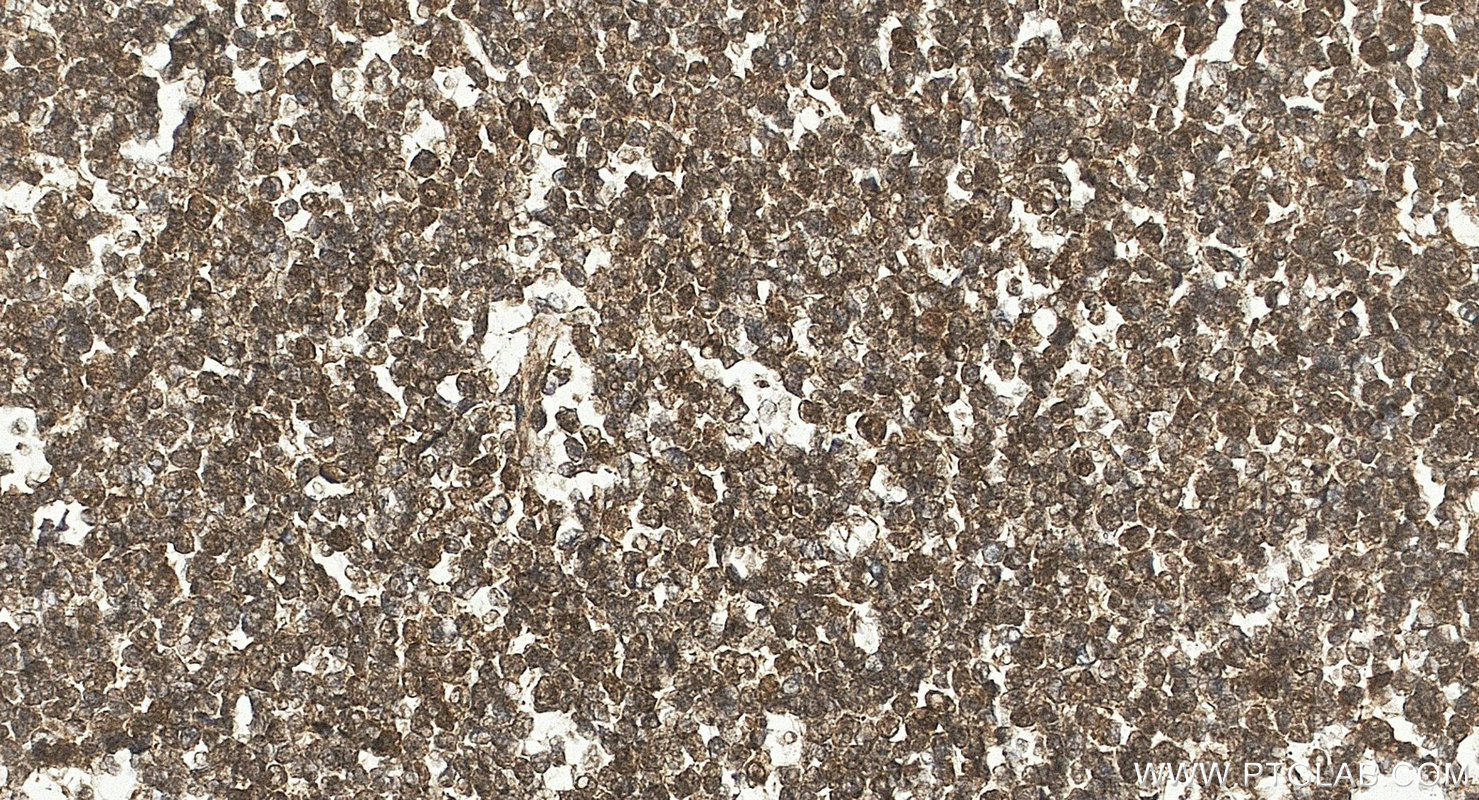IHC staining of human lymphoma using 10867-2-AP IHC staining of human lymphoma using 10867-2-AP