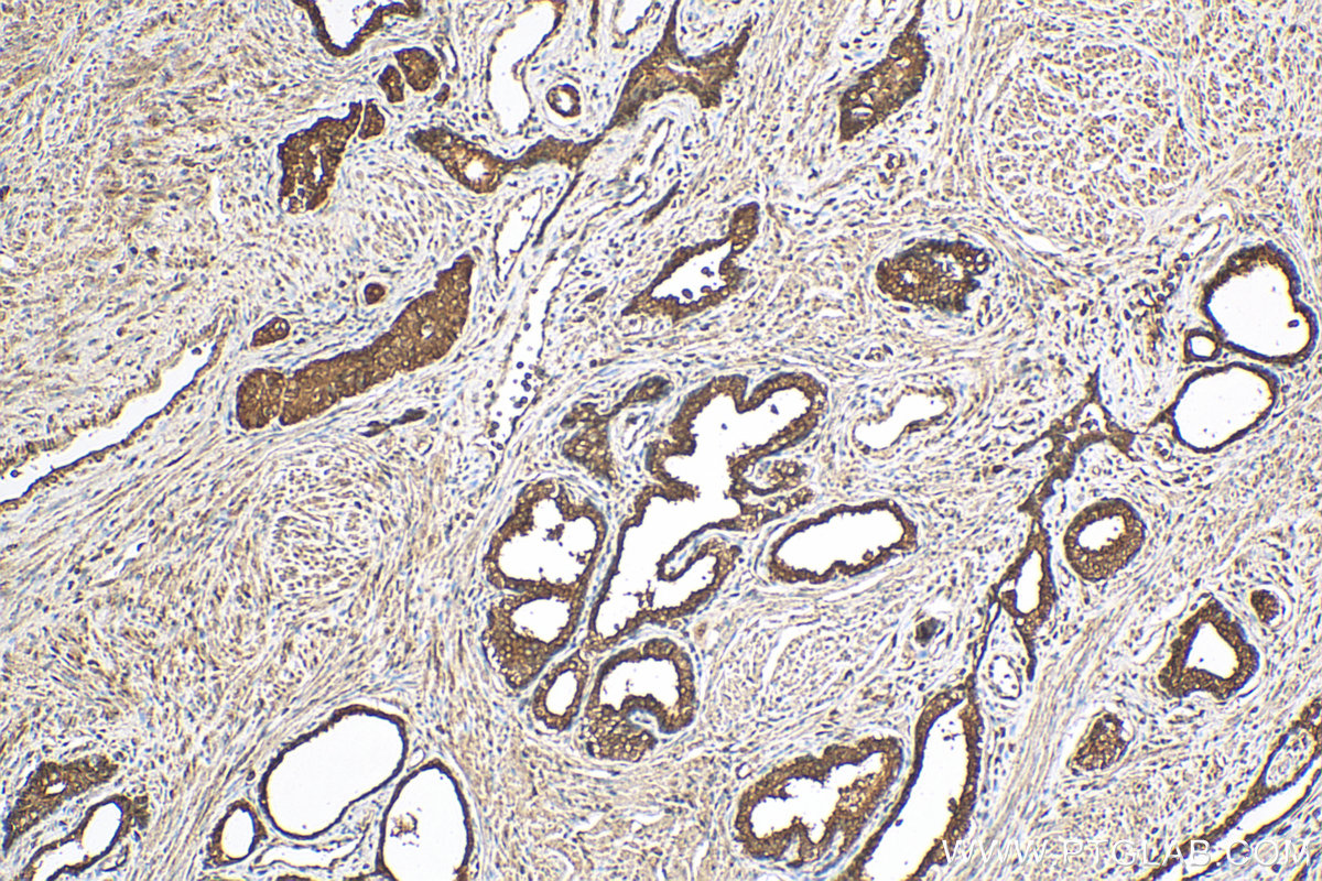 IHC staining of human prostate cancer using 16643-1-AP
