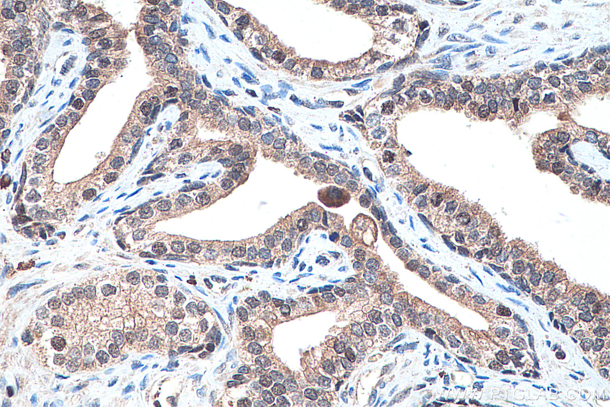 IHC staining of human prostate cancer using 22061-1-AP
