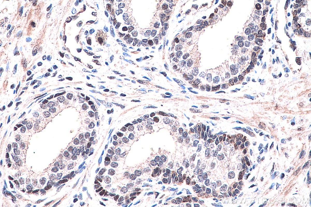 IHC staining of human prostate cancer using 60127-1-Ig