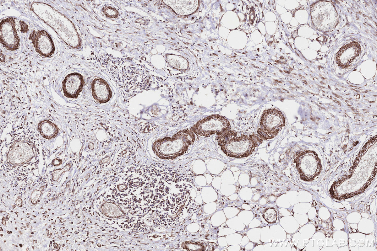 IHC staining of human colon cancer using 85096-1-RR IHC staining of human colon cancer using 85096-1-RR