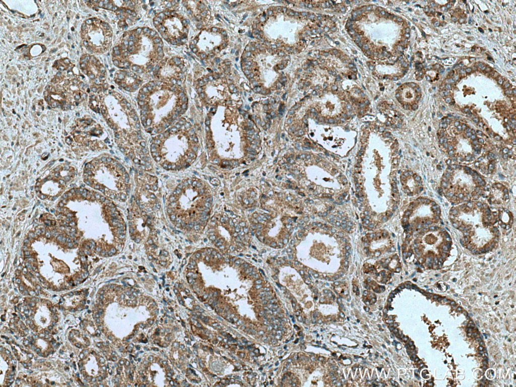 IHC staining of human prostate cancer using 14175-1-AP