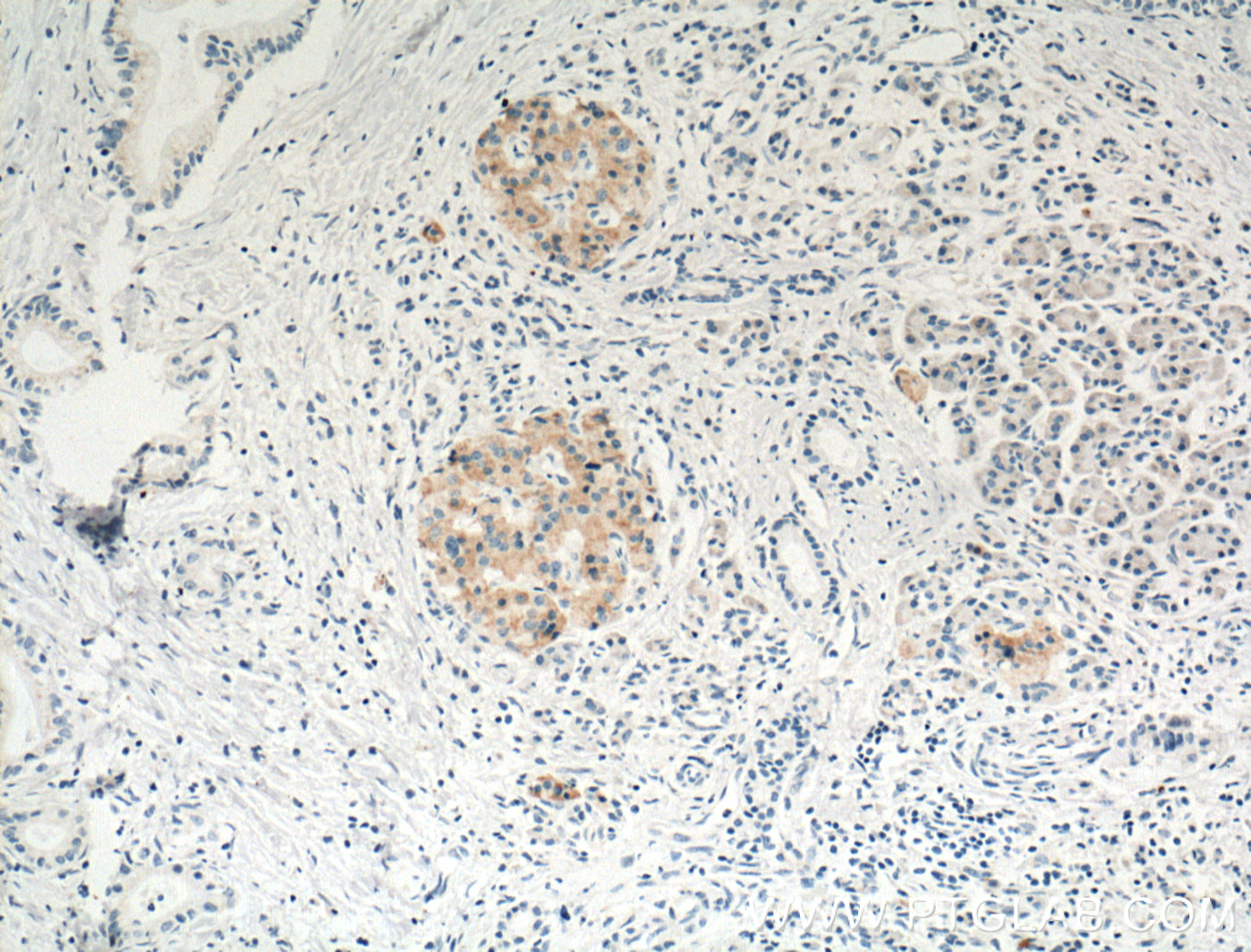 IHC staining of human pancreas cancer using 66047-1-Ig (same clone as 66047-1-PBS)
