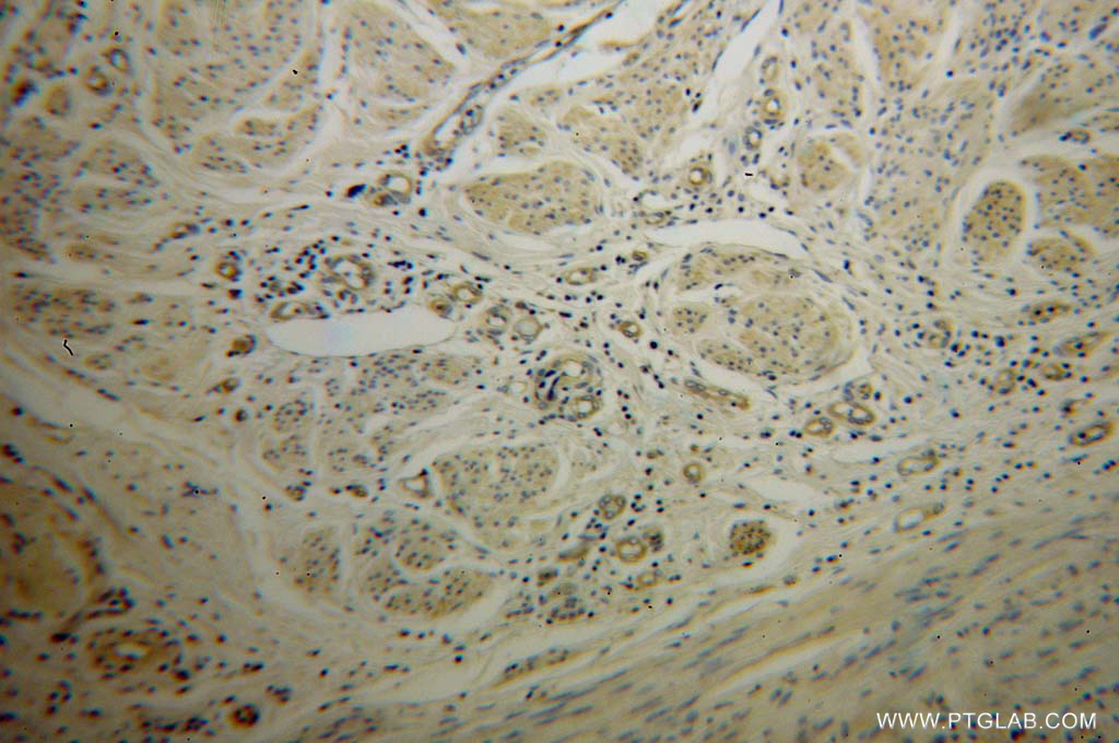 IHC staining of human cervical cancer using 12716-1-AP