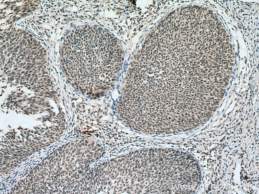 IHC staining of human cervical cancer using 67632-1-Ig (same clone as 67632-1-PBS)