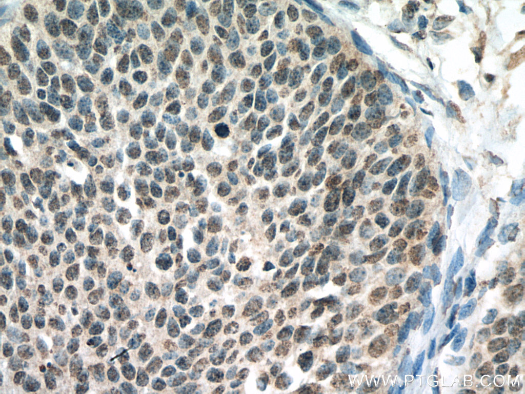 IHC staining of human cervical cancer using 67632-1-Ig (same clone as 67632-1-PBS)